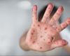 PAHO warns of surge in measles cases