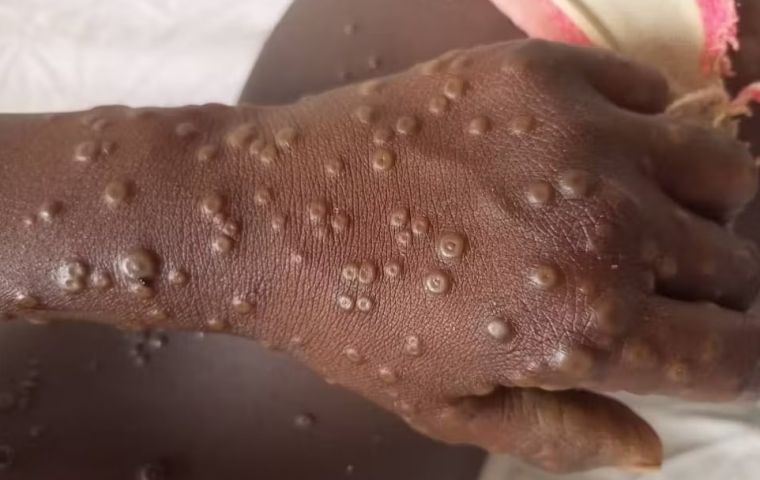 “Mpox remains a serious public health emergency in Africa,” CDC Africa's Director warned 