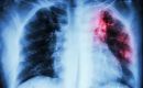 Tuberculosis and Covid-19 are both respiratory diseases with similar symptoms