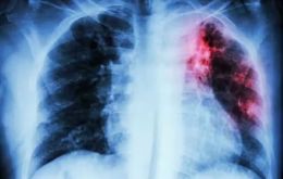 Tuberculosis and Covid-19 are both respiratory diseases with similar symptoms