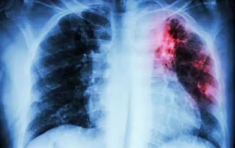 Tuberculosis and Covid-19 are both respiratory diseases with similar symptoms