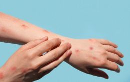 A health emergency is declared nationwide for measles at the request of the National Strategic Council for Health Emergencies, Castro announced 