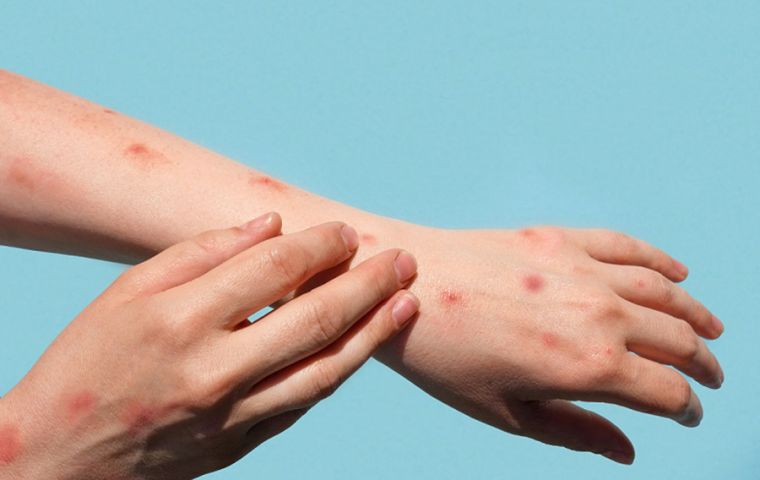 A health emergency is declared nationwide for measles at the request of the National Strategic Council for Health Emergencies, Castro announced