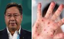 Arce meant that measles spreads faster and wider than Covid-19
