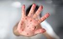 Chickenpox, caused by the varicella-zoster virus, is highly contagious