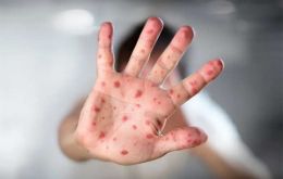 Chickenpox, caused by the varicella-zoster virus, is highly contagious
