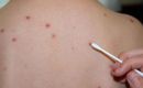 Authorities are focused on vaccination and raising public awareness
