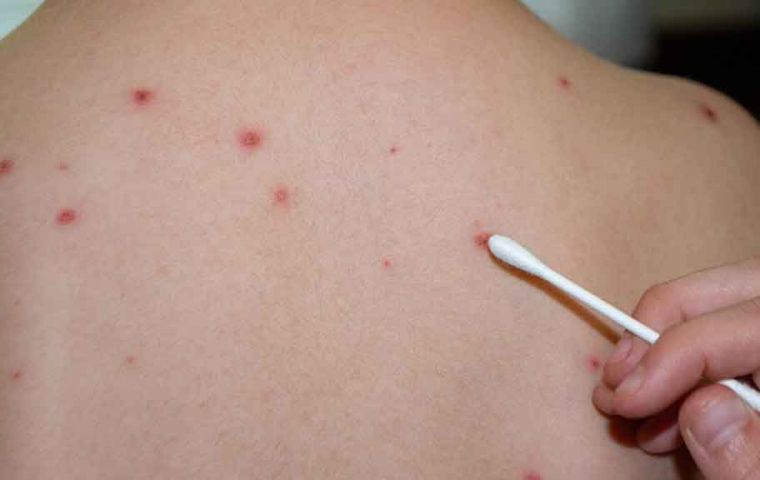 Authorities are focused on vaccination and raising public awareness