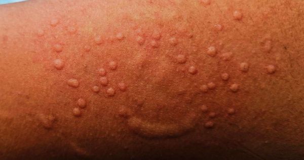 New strain of mpox detected in UK