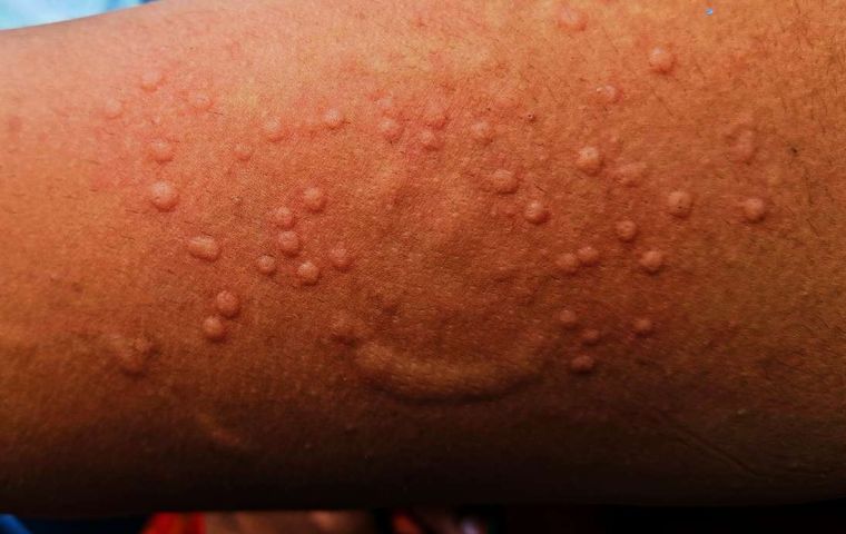 “Although infection with the mpox virus is benign for many, it can be serious,” Dr. Sinka warned