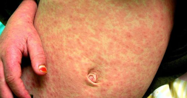 Peru declares health alert over H3N2 and measles