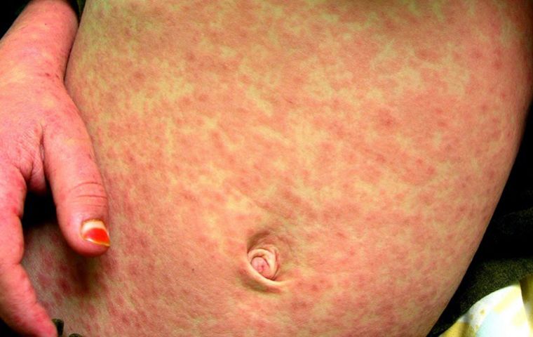 Travelers returning from Europe or the United States must be alert for respiratory symptoms, the Peruvian authorities highlighted