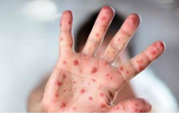 According to the PAHO update, 126 measles cases, including 53 deaths, were reported from the Yanomami communities in Alto Orinoco, state of Amazonas