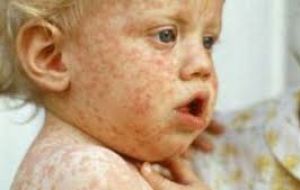 Measles is a highly contagious viral disease that can cause hearing loss and brain disorders in children, and in severe cases, can kill.