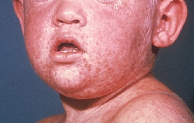 Measles is more contagious than tuberculosis or Ebola, yet it is eminently preventable with a vaccine that costs pennies