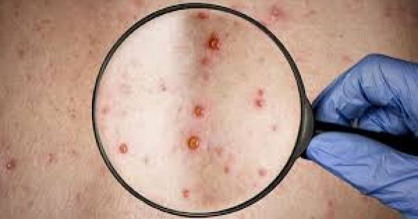 Brazil reports first death of patient with monkeypox - Vimarsana News